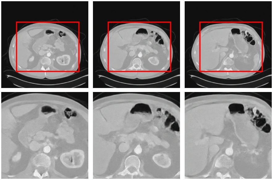 Figure 5: CT slices and enlarged details generated by Lad on AbdomenCT-1K